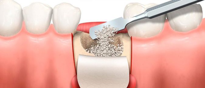 Preservación Alveolar. Clínica Dental Triana, Sevilla